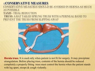 oCONSERVATIVE MEASURES
CONSERVATIVE MEASURES SHOULD BE AVOIDED IN HERNIAAS MUCH
AS POSSIBLE
TAXIS –TRIAL REDUCTION
TRUSS: A RAT TAILED SPRUNG TRUSS WITH A PERINEAL BAND TO
PREVENT THE TRUSS FROM SLIPPING AWAY
Hernia truss: It is used only when patient is not fit for surgery. It may precipitate
strangulation. Before placing truss, contents of the hernia should be reduced
completely a properly fitting truss must control the hernia when the patient stands
with leg apart, stoops & cough violently.
 