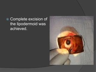  Complete excision of
the lipodermoid was
achieved.
 