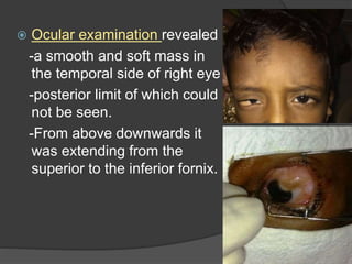  Ocular examination revealed
-a smooth and soft mass in
the temporal side of right eye
-posterior limit of which could
not be seen.
-From above downwards it
was extending from the
superior to the inferior fornix.
 