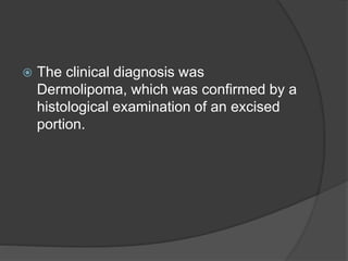  The clinical diagnosis was
Dermolipoma, which was confirmed by a
histological examination of an excised
portion.
 