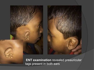 ENT examination revealed preauricular
tags present in both ears
 