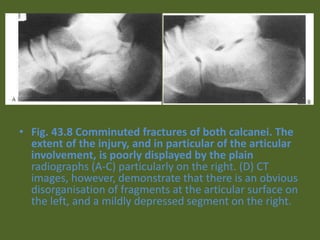 • Fig. 43.8 Comminuted fractures of both calcanei. The
extent of the injury, and in particular of the articular
involvement, is poorly displayed by the plain
radiographs (A-C) particularly on the right. (D) CT
images, however, demonstrate that there is an obvious
disorganisation of fragments at the articular surface on
the left, and a mildly depressed segment on the right.
 