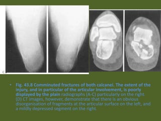 • Fig. 43.8 Comminuted fractures of both calcanei. The extent of the
injury, and in particular of the articular involvement, is poorly
displayed by the plain radiographs (A-C) particularly on the right.
(D) CT images, however, demonstrate that there is an obvious
disorganisation of fragments at the articular surface on the left, and
a mildly depressed segment on the right.
 
