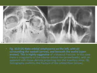 • Fig. 43.9 (A) Note orbital emphysema on the left, with air
surrounding the eyeball (arrow), and beneath the eyelid (open
arrows). This is highly suggestive of a blowout fracture. In this case
there is irregularity of the inferior orbital rim (arrowheads), with an
apparent soft-tissue density projecting into the maxillary sinus. (B)
Tomography confirms the fracture of the orbital floor (arrow).
 