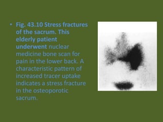 • Fig. 43.10 Stress fractures
of the sacrum. This
elderly patient
underwent nuclear
medicine bone scan for
pain in the lower back. A
characteristic pattern of
increased tracer uptake
indicates a stress fracture
in the osteoporotic
sacrum.
 