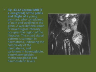 • Fig. 43.12 Coronal MRI (T
2 -weighted) of the pelvis
and thighs of a young
gymnast, who complained
of pain and swelling in the
groin. A well defined lesion
of mixed signal intensity
occupies the region of the
iliopsoas. The mixed signal
pattern is common in
haematoma, indicating the
complexity of the
haematoma, and
variations in haemoglobin,
deoxyhaemoglobin,
methaemoglobin and
haemosiderin levels.
 