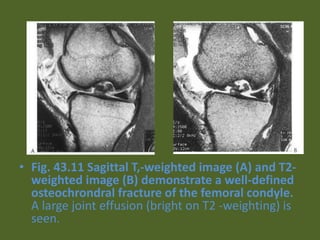 • Fig. 43.11 Sagittal T,-weighted image (A) and T2-
weighted image (B) demonstrate a well-defined
osteochrondral fracture of the femoral condyle.
A large joint effusion (bright on T2 -weighting) is
seen.
 