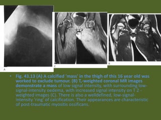 • Fig. 43.13 (A) A calcified 'mass' in the thigh of this 16 year old was
worked to exclude tumour. (B) T,-weighted coronal MR images
demonstrate a mass of low signal intensity, with surrounding low-
signal-intensity oedema, with increased signal intensity on T 2 -
weighted images (C). There is also a welldefined, low-signal-
intensity 'ring' of calcification. Their appearances are characteristic
of post-traumatic myositis ossificans.
 