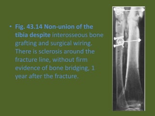 • Fig. 43.14 Non-union of the
tibia despite interosseous bone
grafting and surgical wiring.
There is sclerosis around the
fracture line, without firm
evidence of bone bridging, 1
year after the fracture.
 