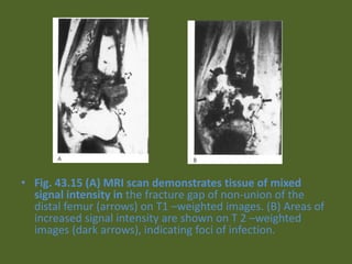 • Fig. 43.15 (A) MRI scan demonstrates tissue of mixed
signal intensity in the fracture gap of non-union of the
distal femur (arrows) on T1 –weighted images. (B) Areas of
increased signal intensity are shown on T 2 –weighted
images (dark arrows), indicating foci of infection.
 