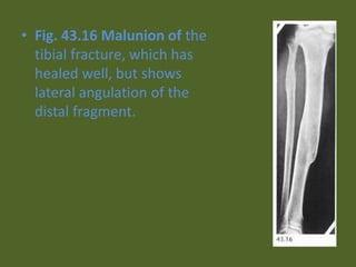 • Fig. 43.16 Malunion of the
tibial fracture, which has
healed well, but shows
lateral angulation of the
distal fragment.
 