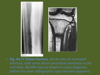 • Fig. 43.17 Stress fracture. (A) An area of increased
sclerosis, with some dense periosteal new bone in the
mid tibia. (B) MRI may be helpful in early diagnosis
before the plain radiographic signs become apparent.
 