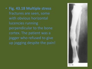 • Fig. 43.18 Multiple stress
fractures are seen, some
with obvious horizontal
lucencies running
perpendicular to the bone
cortex. The patient was a
jogger who refused to give
up jogging despite the pain!
 