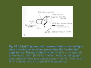 • Fig. 43.19 (A) Diagrammatic representation of an oblique
view of a lumbar vertebra, presenting the 'scotty dog'
appearance. The pars interarticularis defect corresponds
to the dog's collar. (B, C) Pars defect: oblique radiograph
demonstrates the same appearances as in (A). (Courtesy of
Dr D. J. Stoker and Institute of Orthopaedics.)
 