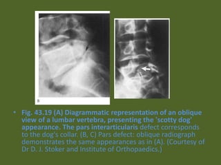 • Fig. 43.19 (A) Diagrammatic representation of an oblique
view of a lumbar vertebra, presenting the 'scotty dog'
appearance. The pars interarticularis defect corresponds
to the dog's collar. (B, C) Pars defect: oblique radiograph
demonstrates the same appearances as in (A). (Courtesy of
Dr D. J. Stoker and Institute of Orthopaedics.)
 