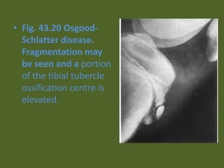 • Fig. 43.20 Osgood-
Schlatter disease.
Fragmentation may
be seen and a portion
of the tibial tubercle
ossification centre is
elevated.
 