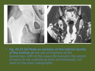 • Fig. 43.21 (A) Note an avulsion of the inferior border
of the ischium at the site of insertion of the
hamstrings. MRI of this injury (B) indicates the extent
of injury to the underlying bone (arrowheads), not
seen on the plain radiographs.
 