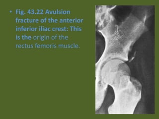 • Fig. 43.22 Avulsion
fracture of the anterior
inferior iliac crest: This
is the origin of the
rectus femoris muscle.
 