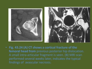 • Fig. 43.24 (A) CT shows a cortical fracture of the
femoral head from previous posterior hip dislocation.
A small intra-articular fragment is seen. (B) MRI scan
performed several weeks later, indicates the typical
findings of avascular necrosis.
 