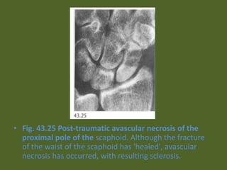 • Fig. 43.25 Post-traumatic avascular necrosis of the
proximal pole of the scaphoid. Although the fracture
of the waist of the scaphoid has 'healed', avascular
necrosis has occurred, with resulting sclerosis.
 