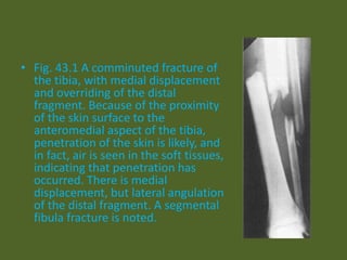 • Fig. 43.1 A comminuted fracture of
the tibia, with medial displacement
and overriding of the distal
fragment. Because of the proximity
of the skin surface to the
anteromedial aspect of the tibia,
penetration of the skin is likely, and
in fact, air is seen in the soft tissues,
indicating that penetration has
occurred. There is medial
displacement, but lateral angulation
of the distal fragment. A segmental
fibula fracture is noted.
 
