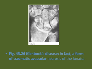 • Fig. 43.26 Kienbock's disease: in fact, a form
of traumatic avascular necrosis of the lunate.
 