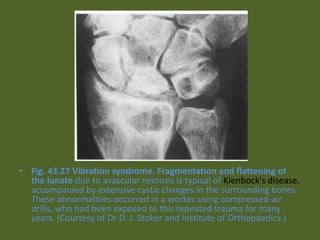 • Fig. 43.27 Vibration syndrome. Fragmentation and flattening of
the lunate due to avascular necrosis is typical of Kienbock's disease,
accompanied by extensive cystic changes in the surrounding bones.
These abnormalities occurred in a worker using compressed-air
drills, who had been exposed to this repeated trauma for many
years. (Courtesy of Dr D. J. Stoker and Institute of Orthopaedics.)
 
