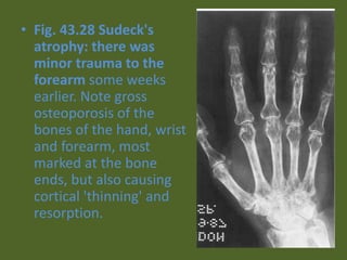 • Fig. 43.28 Sudeck's
atrophy: there was
minor trauma to the
forearm some weeks
earlier. Note gross
osteoporosis of the
bones of the hand, wrist
and forearm, most
marked at the bone
ends, but also causing
cortical 'thinning' and
resorption.
 