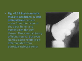 • Fig. 43.29 Post-traumatic
myositis ossificans. A well-
defined bone density
arises from the cortex of
the distal femur and
extends into the soft
tissues. There was a history
of blunt trauma, but even
so, this lesion needs to be
differentiated from
parosteal osteosarcoma.
 