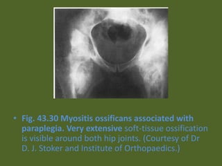 • Fig. 43.30 Myositis ossificans associated with
paraplegia. Very extensive soft-tissue ossification
is visible around both hip joints. (Courtesy of Dr
D. J. Stoker and Institute of Orthopaedics.)
 