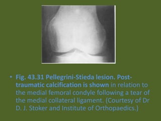 • Fig. 43.31 Pellegrini-Stieda lesion. Post-
traumatic calcification is shown in relation to
the medial femoral condyle following a tear of
the medial collateral ligament. (Courtesy of Dr
D. J. Stoker and Institute of Orthopaedics.)
 