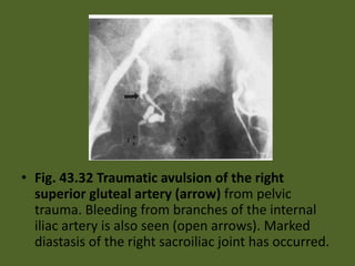 • Fig. 43.32 Traumatic avulsion of the right
superior gluteal artery (arrow) from pelvic
trauma. Bleeding from branches of the internal
iliac artery is also seen (open arrows). Marked
diastasis of the right sacroiliac joint has occurred.
 