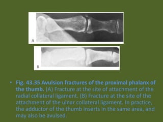 • Fig. 43.35 Avulsion fractures of the proximal phalanx of
the thumb. (A) Fracture at the site of attachment of the
radial collateral ligament. (B) Fracture at the site of the
attachment of the ulnar collateral ligament. In practice,
the adductor of the thumb inserts in the same area, and
may also be avulsed.
 