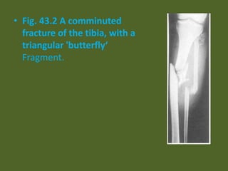 • Fig. 43.2 A comminuted
fracture of the tibia, with a
triangular 'butterfly‘
Fragment.
 