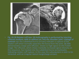 • Fig. 43.36 Rotator cuff tear. (A) Arthrography is performed by injecting
contrast medium, with or without air, into the shoulder joint. Leakage of
contrast into the subdeltoid bursa (arrows) indicates a rupture of the
rotator cuff which normally separates the bursa from the joint. (B) MRI
demonstrates a large joint effusion, shown as high signal on this FLASH
image. The effusion, which shows markedly increased signal intensity on
this sequence, has tracked into the subdeltoid bursa (arrowheads),
indicating rotator cuff rupture. In this case the subscapularis is seen to be
retracted, with an irregular lateral margin(large arrows).
 