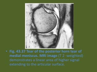• Fig. 43.37 Tear of the posterior horn tear of
medial meniscus. MRI image (T 2 -weighted)
demonstrates a linear area of higher signal
extending to the articular surface.
 
