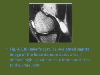 • Fig. 43.38 Baker's cyst. T2 -weighted sagittal
image of the knee demonstrates a well-
defined high-signal-intensity lesion posterior
to the knee joint.
 