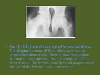 • Fig. 43.42 Bilateral slipped capital femoral epiphyses.
The diagnosis is more difficult when there is such
symmetrical abnormality. There is, however, obvious
blurring of the epiphyseal line, and elongation of the
femoral neck. The femoral head does not project above
the line of the femoral neck on either side.
 