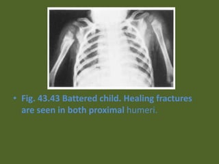 • Fig. 43.43 Battered child. Healing fractures
are seen in both proximal humeri.
 