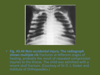 • Fig. 43.44 Non-accidental injury. The radiograph
shows multiple rib fractures at different stages of
healing, probably the result of repeated compression
injuries to the thorax. The child was admitted with a
recent skull fracture. (Courtesy of Dr D. J. Stoker and
Institute of Orthopaedics.)
 