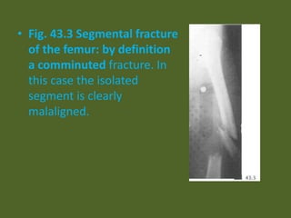 • Fig. 43.3 Segmental fracture
of the femur: by definition
a comminuted fracture. In
this case the isolated
segment is clearly
malaligned.
 