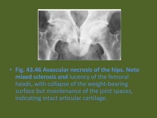 • Fig. 43.46 Avascular necrosis of the hips. Note
mixed sclerosis and lucency of the femoral
heads, with collapse of the weight-bearing
surface but maintenance of the joint spaces,
indicating intact articular cartilage.
 