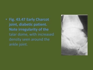 • Fig. 43.47 Early Charcot
joint, diabetic patient.
Note irregularity of the
talar dome, with increased
density seen around the
ankle joint.
 
