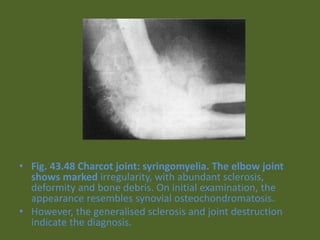 • Fig. 43.48 Charcot joint: syringomyelia. The elbow joint
shows marked irregularity, with abundant sclerosis,
deformity and bone debris. On initial examination, the
appearance resembles synovial osteochondromatosis.
• However, the generalised sclerosis and joint destruction
indicate the diagnosis.
 