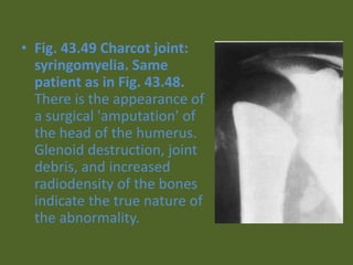 • Fig. 43.49 Charcot joint:
syringomyelia. Same
patient as in Fig. 43.48.
There is the appearance of
a surgical 'amputation' of
the head of the humerus.
Glenoid destruction, joint
debris, and increased
radiodensity of the bones
indicate the true nature of
the abnormality.
 