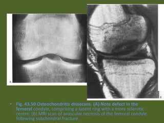 • Fig. 43.50 Osteochondritis dissecans. (A) Note defect in the
femoral condyle, comprising a lucent ring with a more sclerotic
centre. (B) MRI scan of avascular necrosis of the femoral condyle
following subchondral fracture.
 
