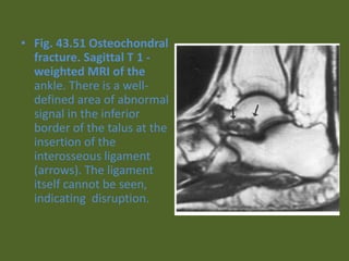 • Fig. 43.51 Osteochondral
fracture. Sagittal T 1 -
weighted MRI of the
ankle. There is a well-
defined area of abnormal
signal in the inferior
border of the talus at the
insertion of the
interosseous ligament
(arrows). The ligament
itself cannot be seen,
indicating disruption.
 