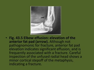 • Fig. 43.5 Elbow effusion: elevation of the
anterior fat pad (arrow). Although not
pathognomonic for fracture, anterior fat pad
elevation indicates significant effusion, and is
frequently associated with a fracture. Careful
inspection of the unfused radial head shows a
minor cortical stepoff of the metaphysis,
indicating a fracture.
 