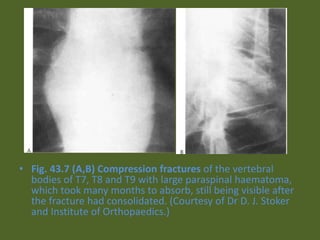• Fig. 43.7 (A,B) Compression fractures of the vertebral
bodies of T7, T8 and T9 with large paraspinal haematoma,
which took many months to absorb, still being visible after
the fracture had consolidated. (Courtesy of Dr D. J. Stoker
and Institute of Orthopaedics.)
 