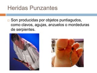 Heridas Punzantes


Son producidas por objetos puntiagudos,
como clavos, agujas, anzuelos o mordeduras
de serpientes.

 